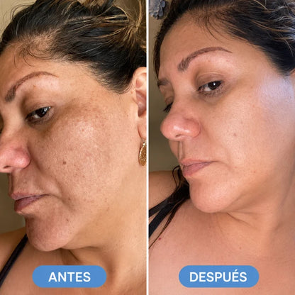 Lindonia® Crema Coreana Antimanchas: Aclara manchas desde la primera semana